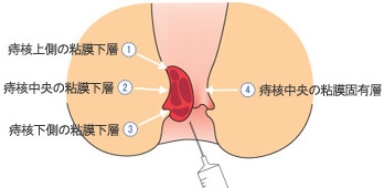 痔の疾患