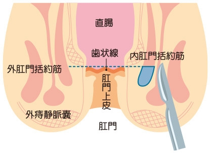 痔の疾患