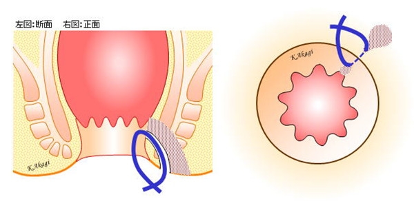 痔の疾患