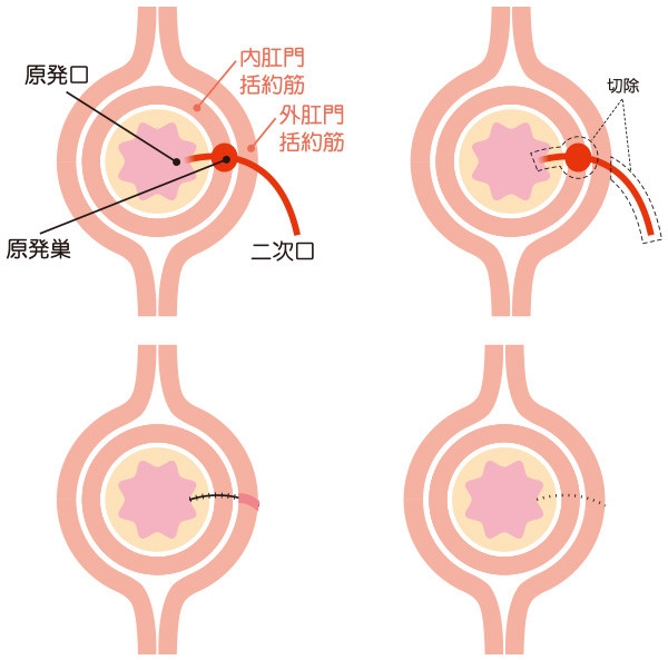 痔の疾患