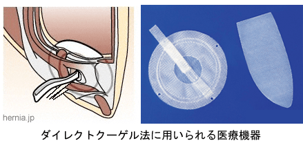 鼠径ヘルニア