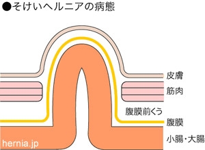 鼠径ヘルニアの症状