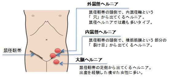 鼠径ヘルニア 脱腸 の治療 手術 再発 臍ヘルニア 腹壁ヘルニア 宮城県仙台市