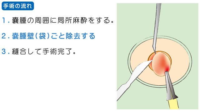 粉瘤（アテローム）の治療・手術