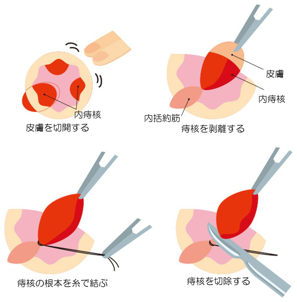 治療 いぼ 痔 痔（切れ痔、いぼ痔、痔ろう）の完治期間／治るまではどれくらい？