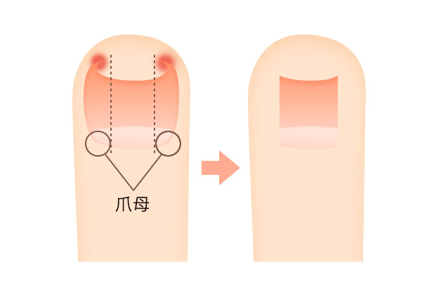 巻き爪・陥入爪の治療方法