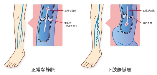 下肢静脈瘤