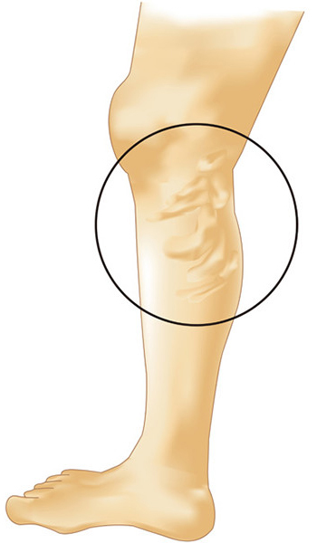 下肢静脈瘤