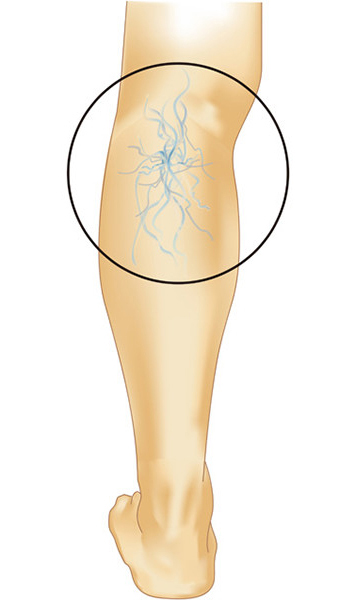 下肢静脈瘤