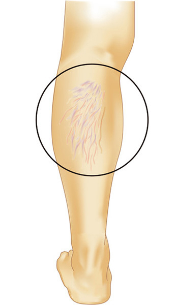 下肢静脈瘤
