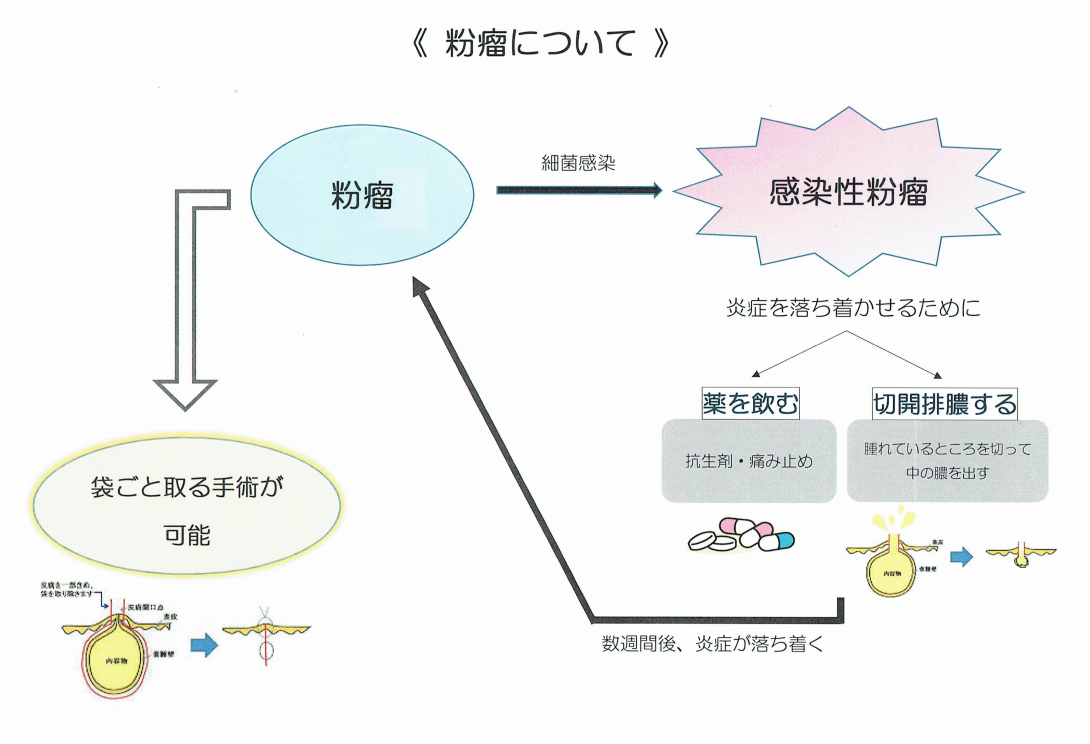 粉瘤とは